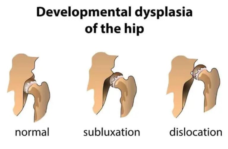 Hip Dysplasia – Hip Scoring in the UK